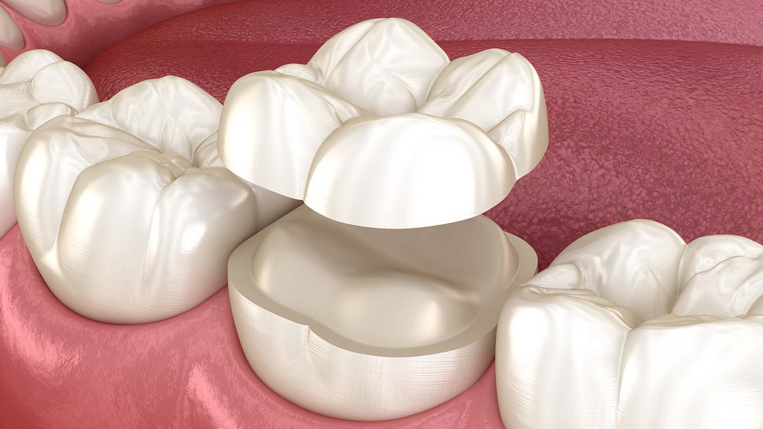 Dental Crowns Lighthouse Dental Centre Langley Dentist